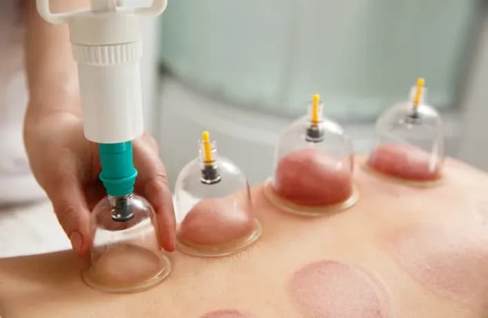 First Response Healthcare physical therapist administering specialized dry cupping therapy during a home physiotherapy visit in Dubai to increase localized blood flow.