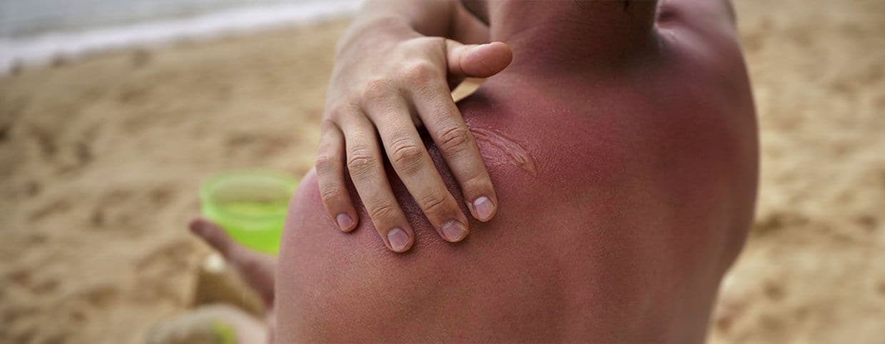 Seek Medical Attention for Severe Sunburn