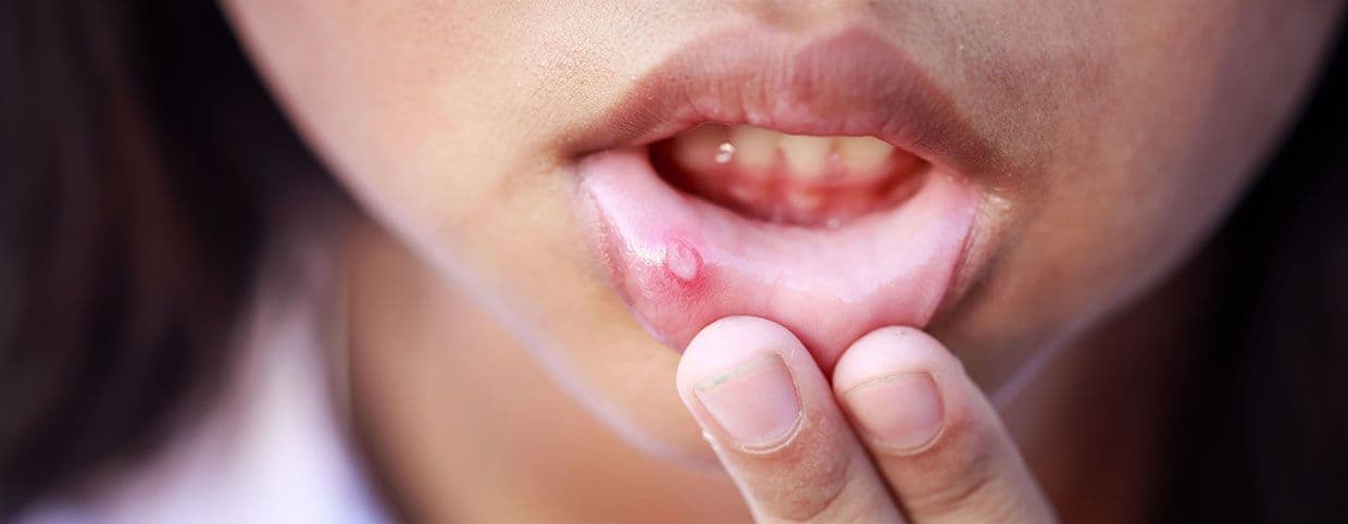Mouth Ulcer Symptoms