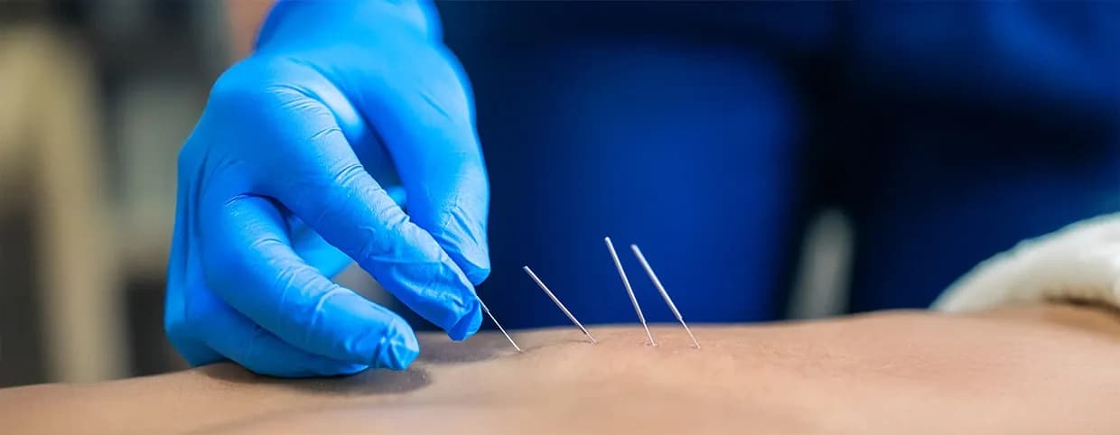 Exploring Dry Needle Therapy
