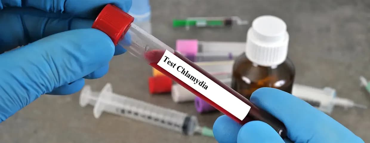 How to Prepare for a Chlamydia Test?