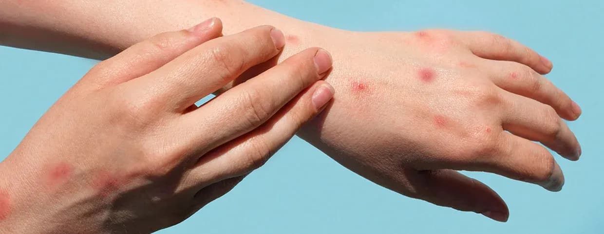 التعرف على أعراض الهربس عند النساء