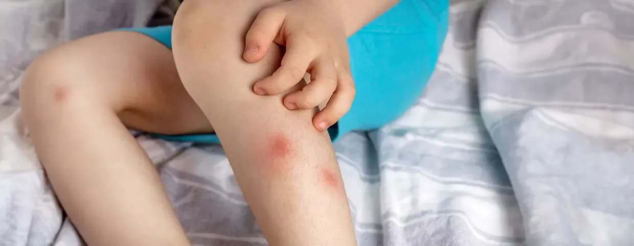 Dengue Fever Prevention Tips and Strategies