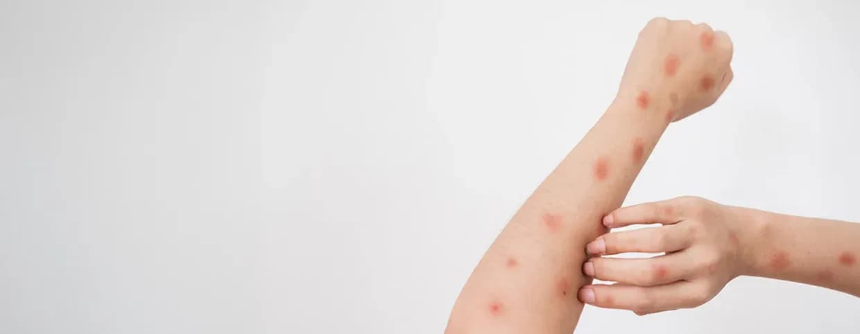 Understanding Mpox: Conclusion